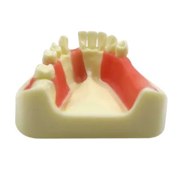 Стоматологическая модель зубов Практическая модель имплантации нижней челюсти Десна с отсутствующими зубами Обучающая модель стоматолога